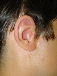 Kõrva protees asetatuna defektile. Foto: autori erakogu.